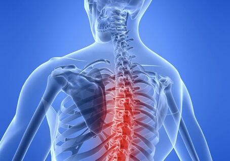 osteochondrosis an spine chliabhraigh