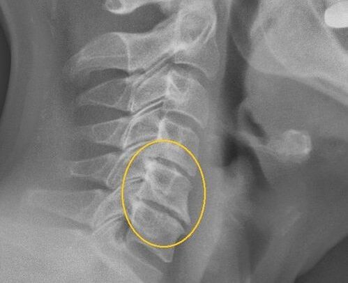 Osteochondrosis an dromlaigh cheirbheacs ar x -ray