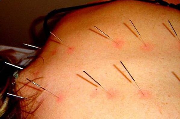 Acupuncture - modh chun osteochondrosis ceirbheacs a chóireáil