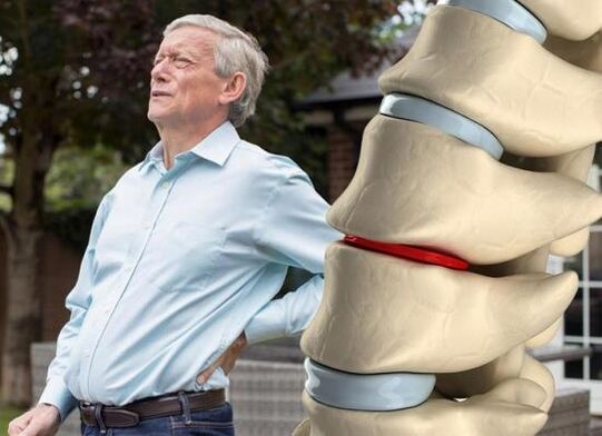 Bíonn tionchar ag osteochondrosis ar na dioscaí intervertebral agus is cúis le pian ar ais