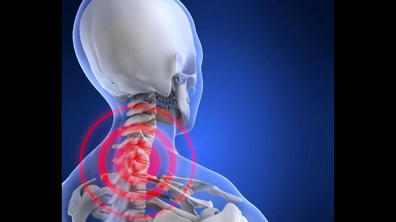 Osteochondrosis an spine cheirbheacsach